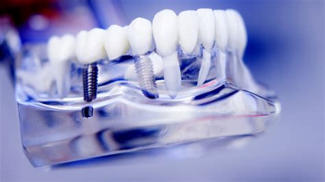  Vanadium-Legierung für die Zukunft des Dentalimplantats: Hochleistung und Biokompatibilität vereint!